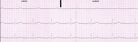 Electrocardiogram_of_a_healthy_man,_21_years_old.jpg